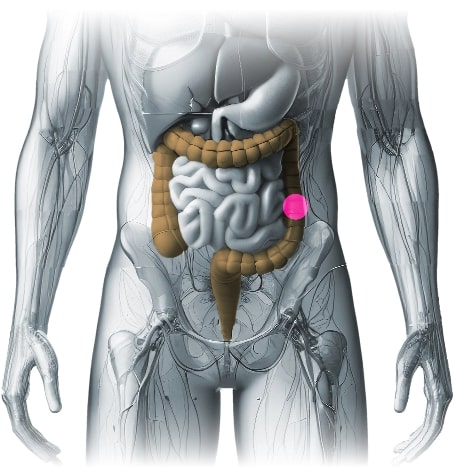 colostomy-pic.jpg