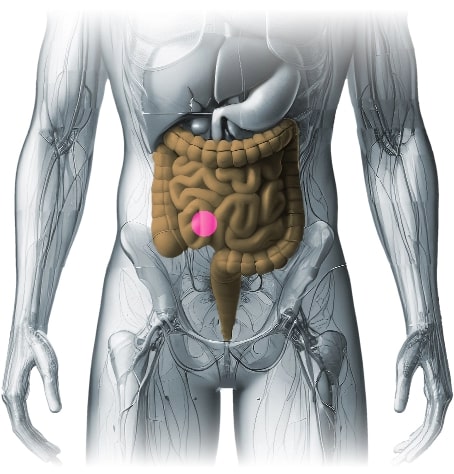 ileostomy-pic.jpg